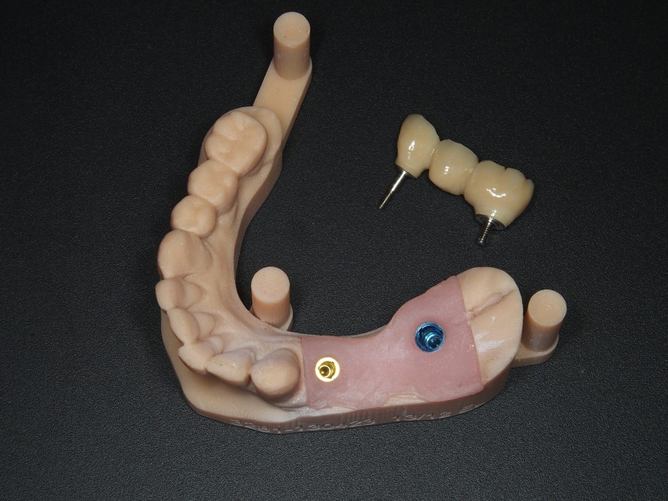 1 brug op 2 implantaten 2