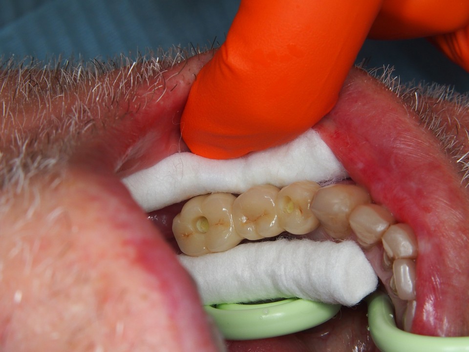 4 wattenbolletje op de schroeven te bescherming