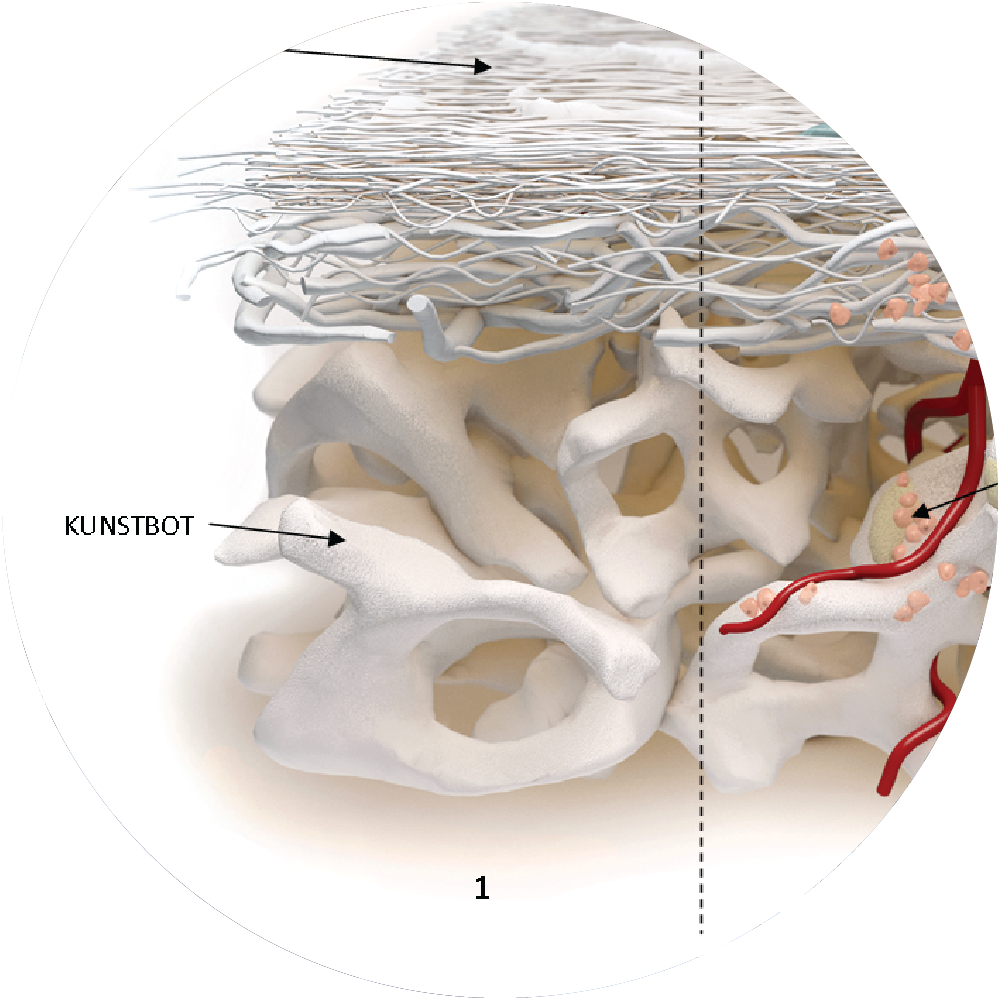 Implantologie Haren Kunstbot