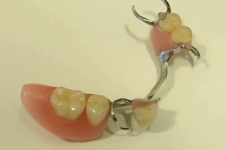 Frameprothese Implantologie Drenthe v2