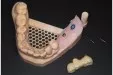Casus 3: 3 delige brug op 2 implantaten in de onderkaak op model