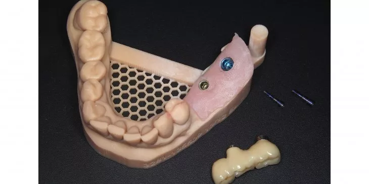 Casus 3: 3 delige brug op 2 implantaten in de onderkaak op model