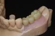 Casus 4: brug op 2 implantaten