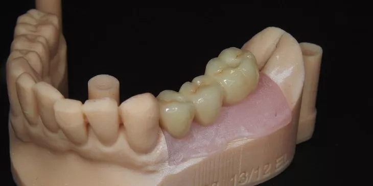 Casus 4: brug op 2 implantaten