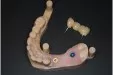 Casus 4: brug op 2 implantaten