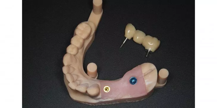 Casus 4: brug op 2 implantaten