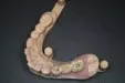 Casus 4: brug op 2 implantaten
