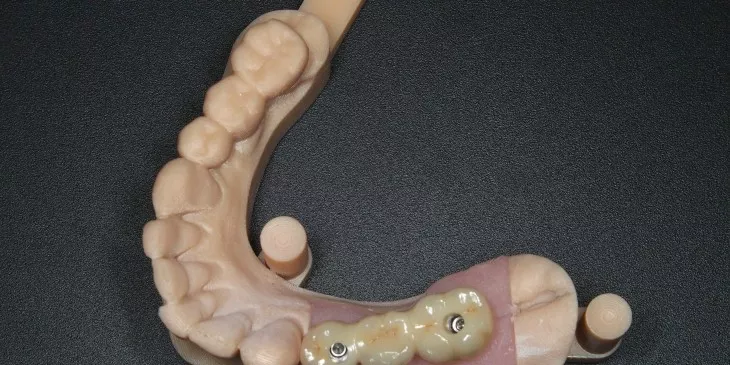 Casus 4: brug op 2 implantaten