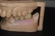 Casus 4: brug op 2 implantaten