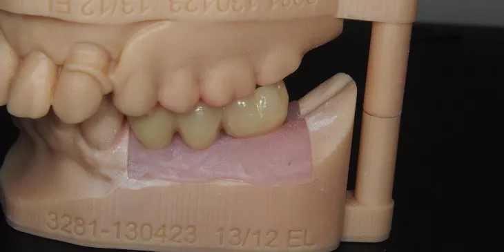 Casus 4: brug op 2 implantaten