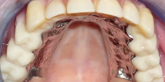 13 klikgebit prothese geplaatst