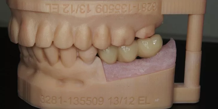 Casus 3: 3-delige brug op 2 implantaten passend bij het bovengebit