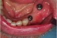Casus 4: genezingsdopjes op de implantaten