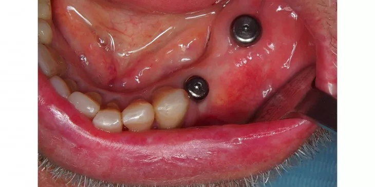 Casus 4: genezingsdopjes op de implantaten