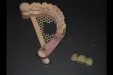 Casus 2: 3-delige brug op twee implantaten in de onderkaak