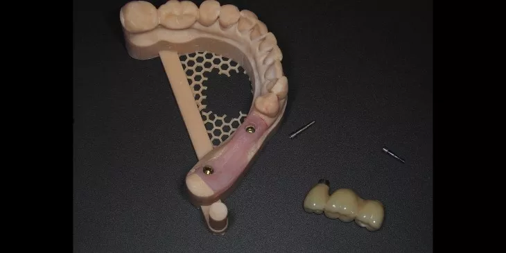 Casus 2: 3-delige brug op twee implantaten in de onderkaak