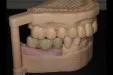 Casus 2: 3-delige brug op twee implantaten in de onderkaak