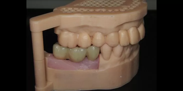 Casus 2: 3-delige brug op twee implantaten in de onderkaak