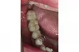 Casus 2: 3-delige brug op twee implantaten in de onderkaak