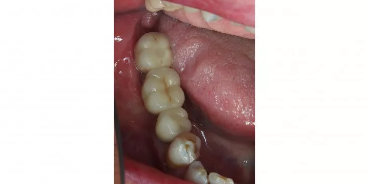 Casus 2: 3-delige brug op twee implantaten in de onderkaak