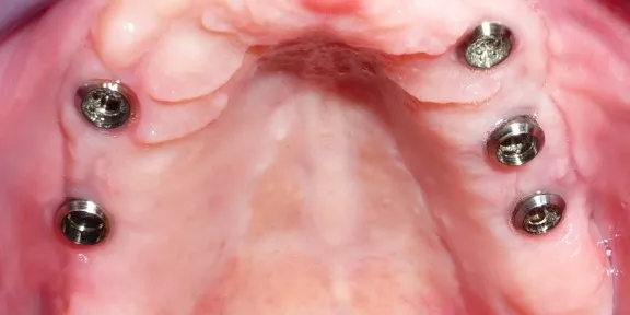 3 klikgebit implantaten zonder genezingsdopje