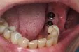 Casus 3: genezingsdopjes nog op de implantaten