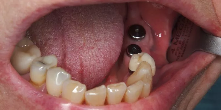 Casus 3: genezingsdopjes nog op de implantaten