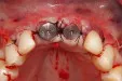 Direct na plaatsen implantaten