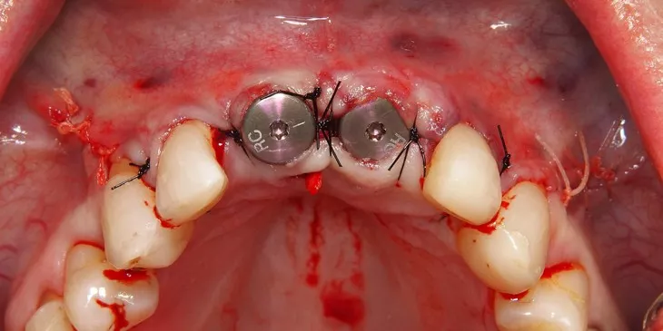 Direct na plaatsen implantaten