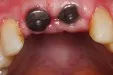4 weken na plaatsen implantaten