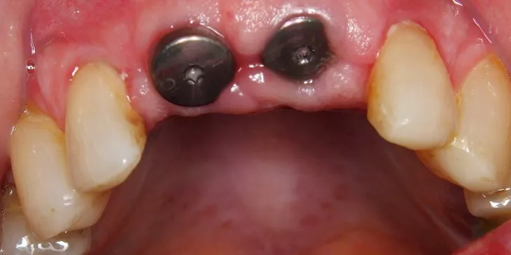 4 weken na plaatsen implantaten