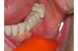 Casus 1: Brug op twee implantaten, dummy voorzijde