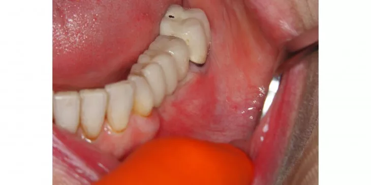 Casus 1: Brug op twee implantaten, dummy voorzijde