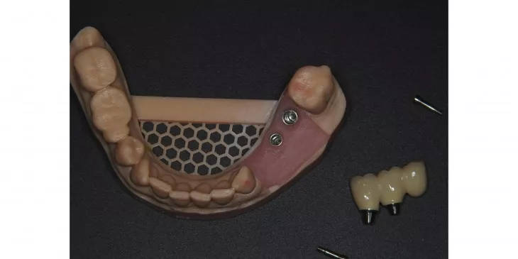 Casus 1: Brug op twee implantaten, dummy voorzijde