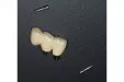 Casus 1: Brug op twee implantaten, dummy voorzijde