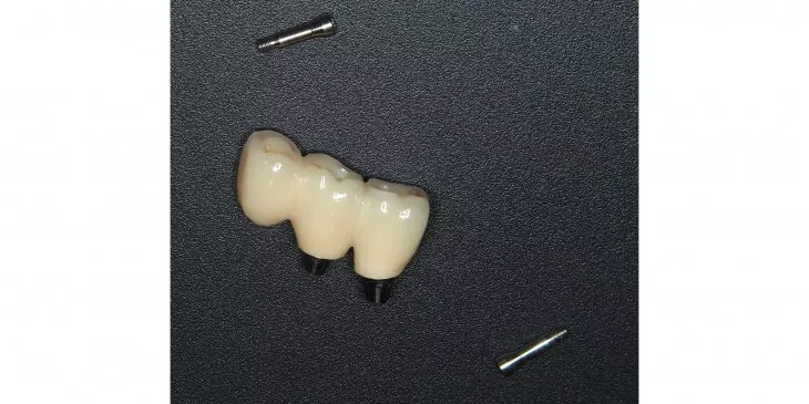 Casus 1: Brug op twee implantaten, dummy voorzijde