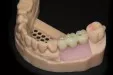 Casus 1: Brug op twee implantaten, dummy voorzijde
