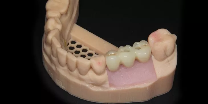 Casus 1: Brug op twee implantaten, dummy voorzijde