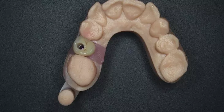 Implantaatkroon kleine kies bovenkaak