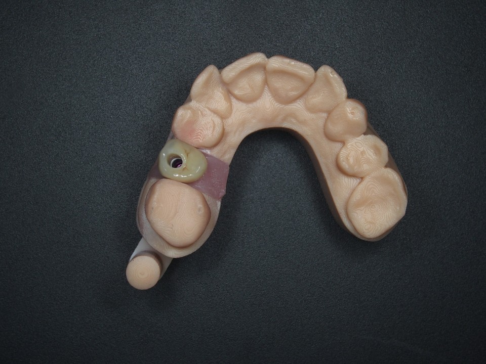 implantaatkroon kleine kies bovenkaak 3